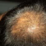After Cancer – What to expect when your hair grows back – 08/27/2021