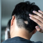 Hair Loss – There are many types