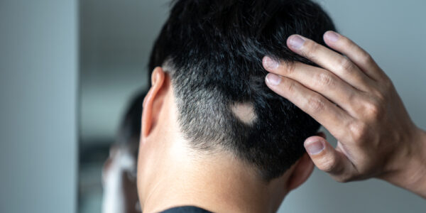 Hair Loss – There are many types