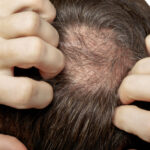 August is National Hair Loss Awareness Month