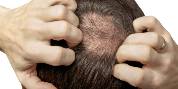 August is National Hair Loss Awareness Month